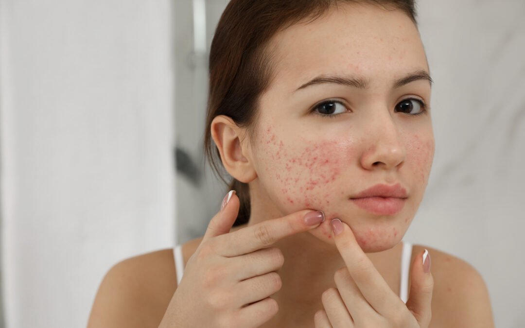 3 Common Causes of Acne