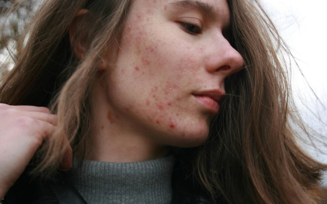 Does Acne Get Worse Before it Gets Better?